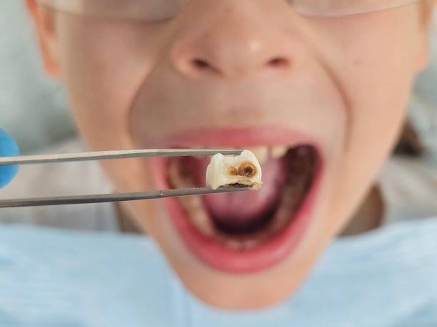 Emergency Dentist for Kids in CA